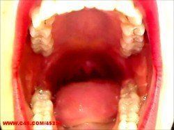 Summers throat uvula reflex